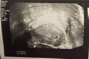 4 6 5ssw Erster Ultraschall Forum Schwangerschaft Urbia De