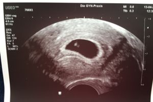 Ultraschallbild An 6 0 Forum Schwangerschaft Urbia De