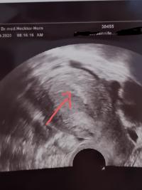 6 Ssw Auf Dem Ultraschall Nichts Zu Sehen Forum Schwangerschaft Urbia De