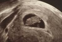Gebärmutter schwangerschaft nach hinten gekippte Umgekehrter Uterus: