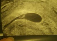 Gekippt gebärmutter schwanger hinten nach Nach hinten