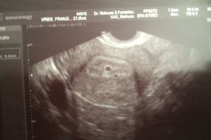 Frühschwangerschaft hellbraune schmierblutung Vaginale Blutungen