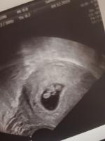 Zervixschleim schwanger brauner Ausfluss in
