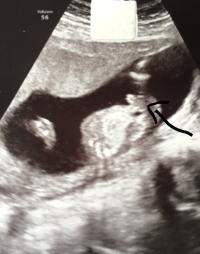 Ultraschall 15 0 Junge Oder Madchen Forum Schwangerschaft Urbia De