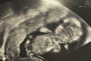 Ssw junge 12 ultraschall Sehr frühes