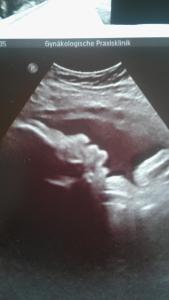 37ssw Ultraschall Komische Nase Forum Schwangerschaft Urbia De