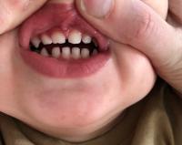 Grau zahn wird Schwarzer Zahn