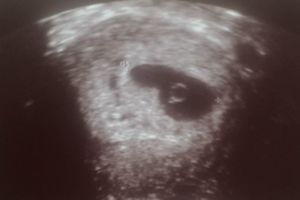 Schwangerschaftsanzeichen braune blutung Bin ich